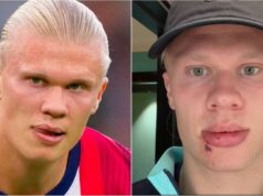 Erling Haaland sofreu uma lesão facial bizarra no ônibus da seleção norueguesa
