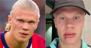 Erling Haaland sofreu uma lesão facial bizarra no ônibus da seleção norueguesa